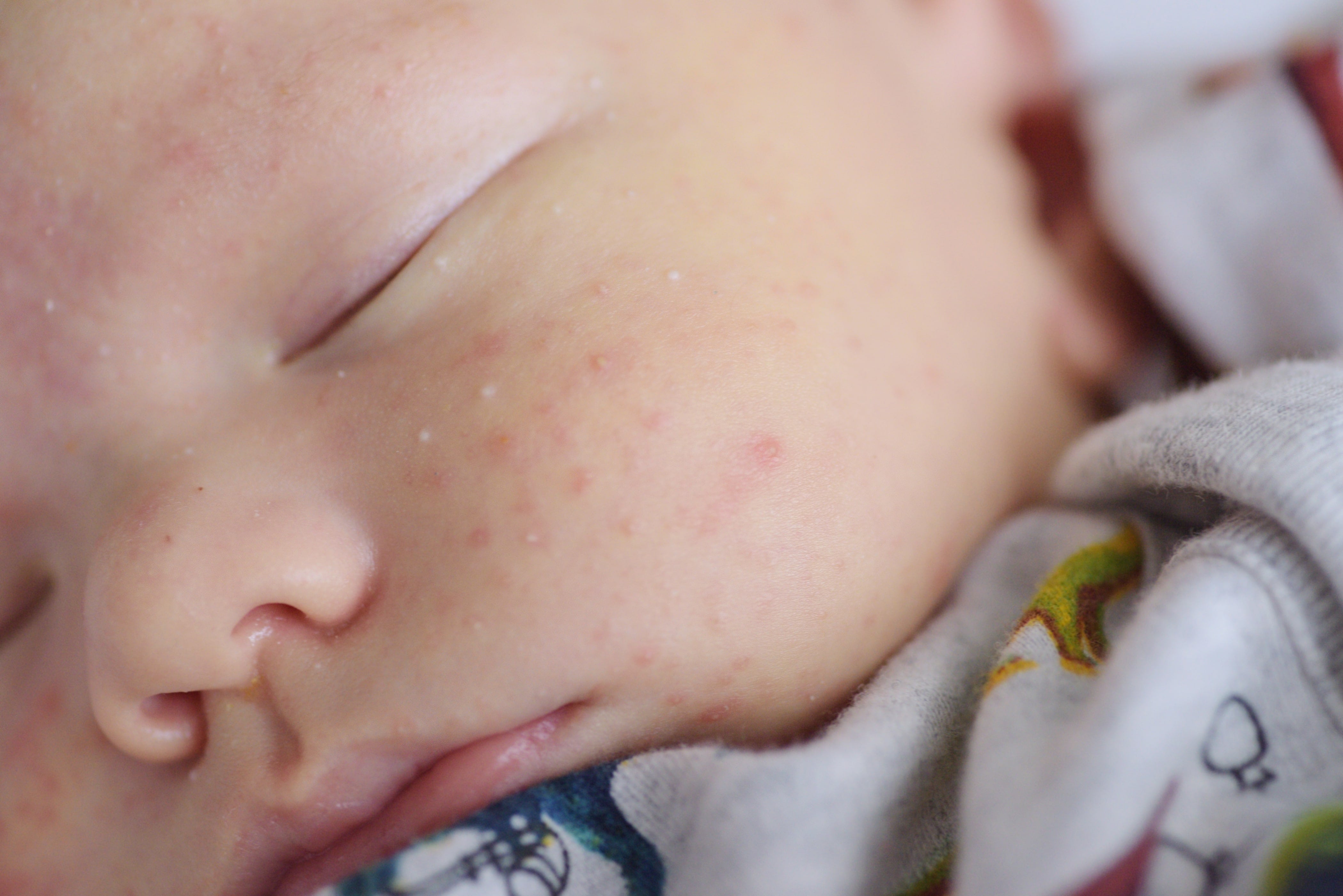 Baby Rashes: A Comprehensive Guide on Prevention and Care – Ola! Otter